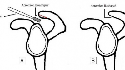 충돌증후군의 외과적 수술이 필요한 경우 shoulder imingement syndrome indication for surgery. indications acromioplasty 견봉성형술 적응증