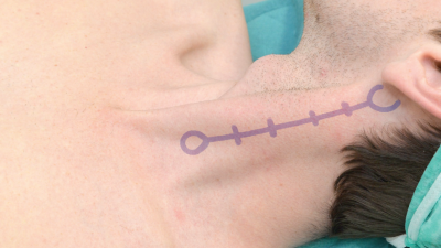 경신경총 cervical plexus block 차단 2